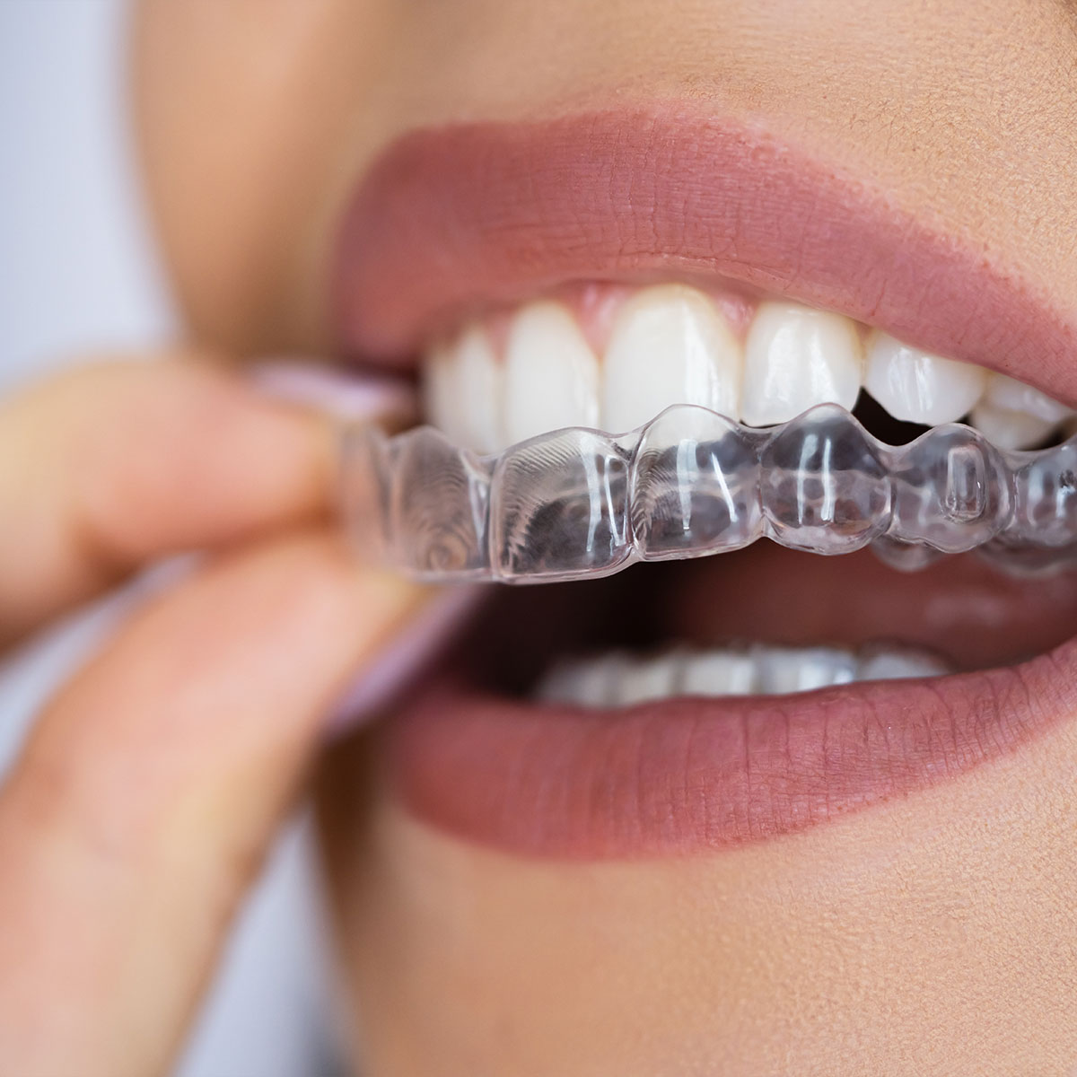 Clear aligner orthodontics