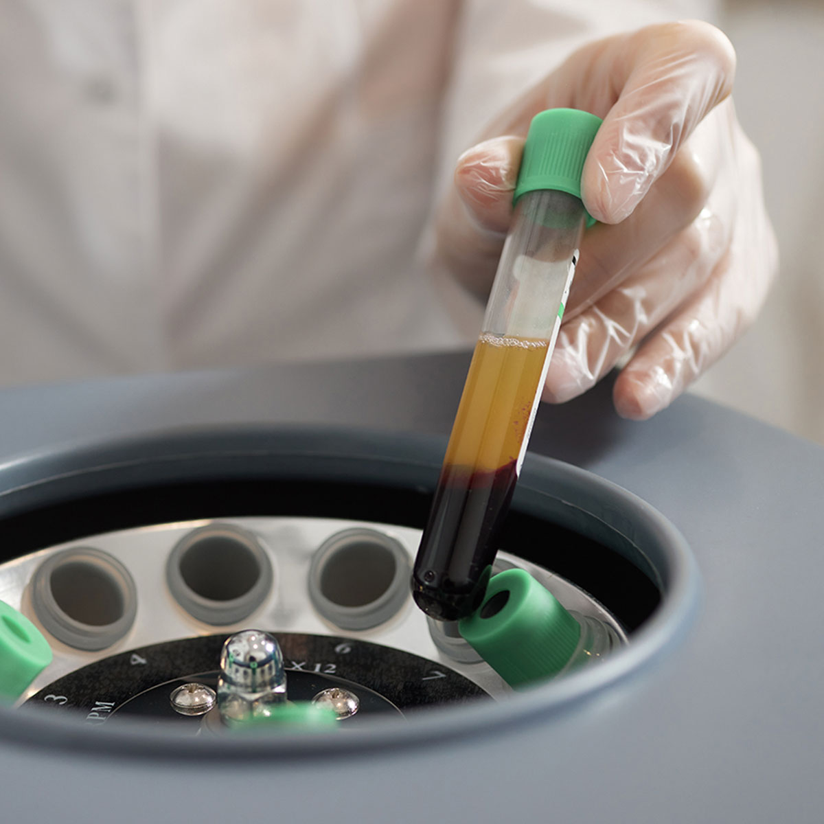 Platelet-rich plasma PRP